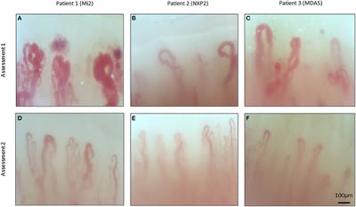 Nailfold Capillaroscopy Abnormalities Correlate With Disease Activity in Adult Dermatomyositis